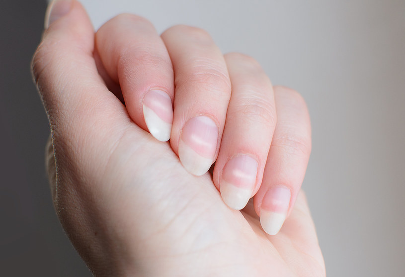 Leukonychię sugerują białe plamy na płytce paznokciowej i pod nią