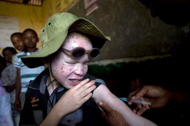 Bezprecedensowe ataki na albinosów. AI krytykuje policję
