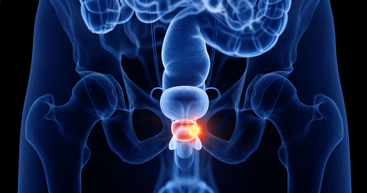 Liczba zachorowań w Polsce na raka prostaty wynosi 16 tys., a ok. 5 tys. mężczyzn rocznie umiera /123RF/PICSEL