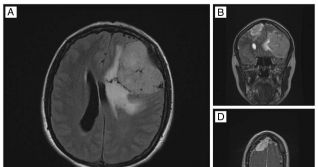 Liczne oponiaki wykryte w mózgu 54-letniej pacjentki /materiały prasowe