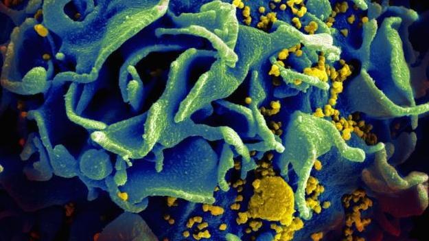 Limfocyt atakowany przez wirusa HIV (Fot. National Institute of Allergy and Infectious Diseases) /materiały prasowe