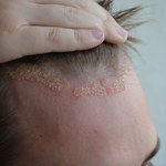 Łojotokowe zapalenie skóry: Przyczyny, objawy i leczenie