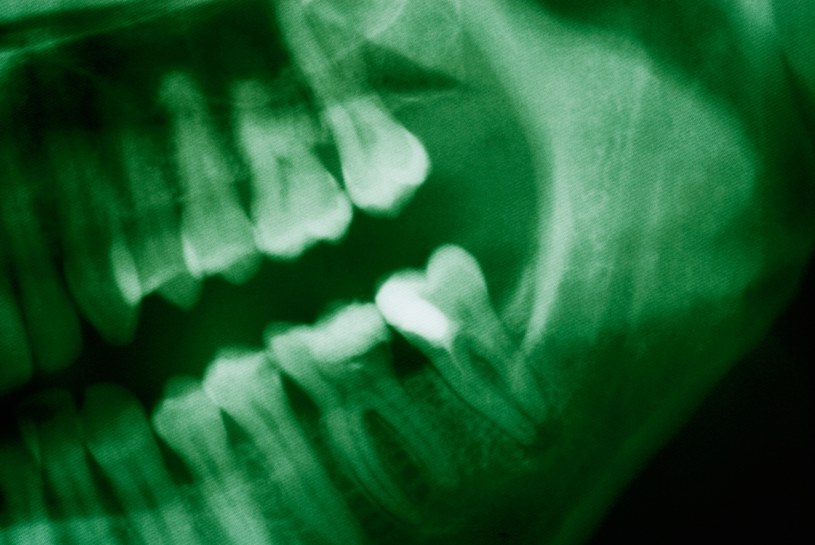 Ludzie pierwotni nie leczyli ubytków, ale i tak mieli dużo zdrowsze zęby od nas /© Glowimages