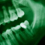 Ludzie prehistoryczni mieli zęby zdrowsze od naszych?