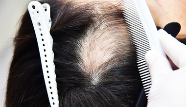 Ludziom wypadają włosy - nowe  powikłanie po koronawirusie
