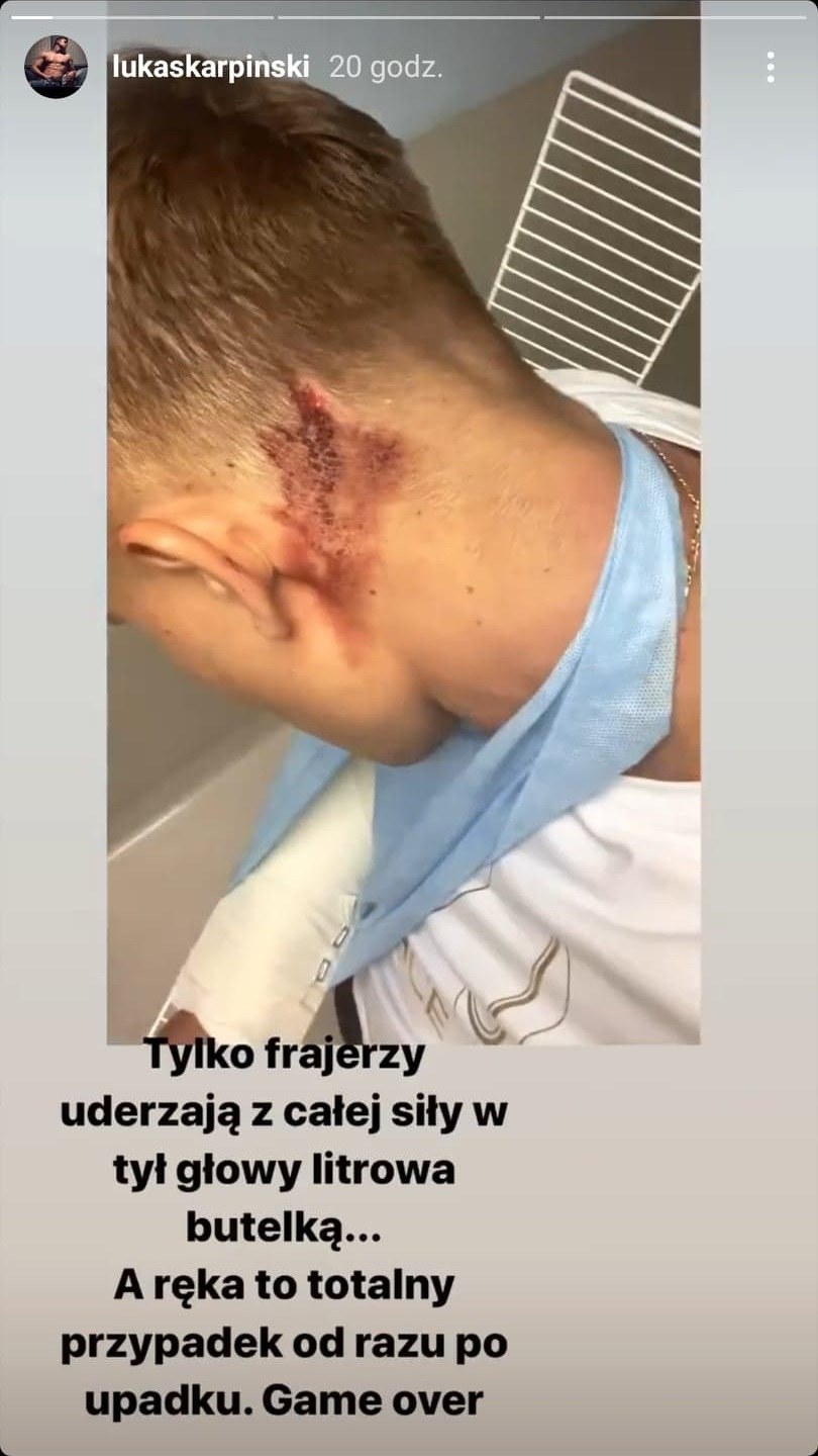 Łukasz Karpiński pokazał skutki pobicia na swoim Instagramie /Instagram