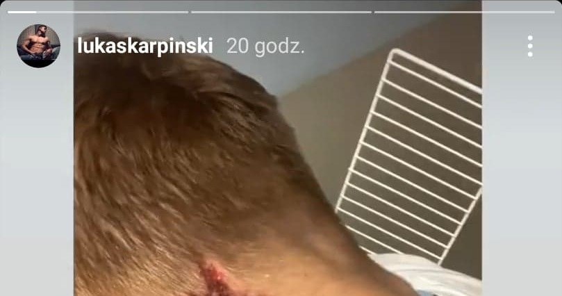 Łukasz Karpiński pokazał skutki pobicia na swoim Instagramie /Instagram