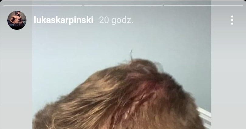 Łukasz Karpiński pokazał skutki pobicia na swoim Instagramie /Instagram