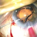 „Lupa” we wnętrzu oka. Zobacz niesamowite nagranie z operacji!