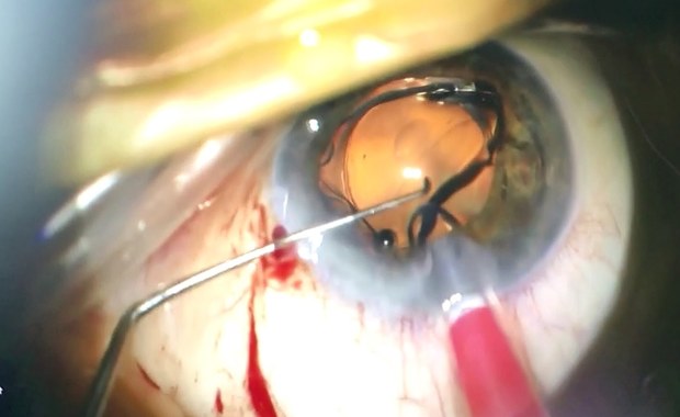 „Lupa” we wnętrzu oka. Zobacz niesamowite nagranie z operacji!