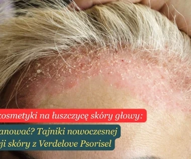 Łuszczyca. Jak ją opanować? Tajniki nowoczesnej pielęgnacji skóry z wykorzystaniem dermokosmetyków