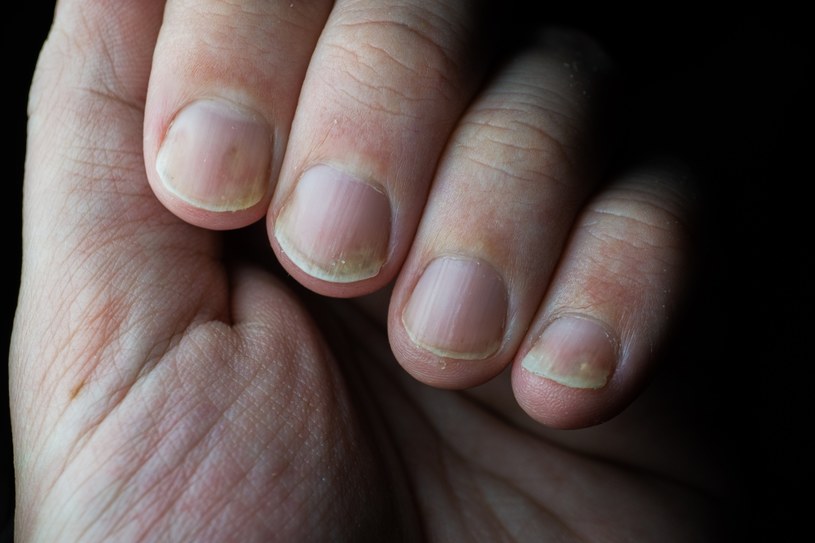 Łuszczyca jest chorobą autoimmunologiczną, a jej objawy mogą występować również na paznokciach /123RF/PICSEL