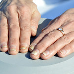 Łuszczyca paznokci - co to za choroba i jak ją leczyć?