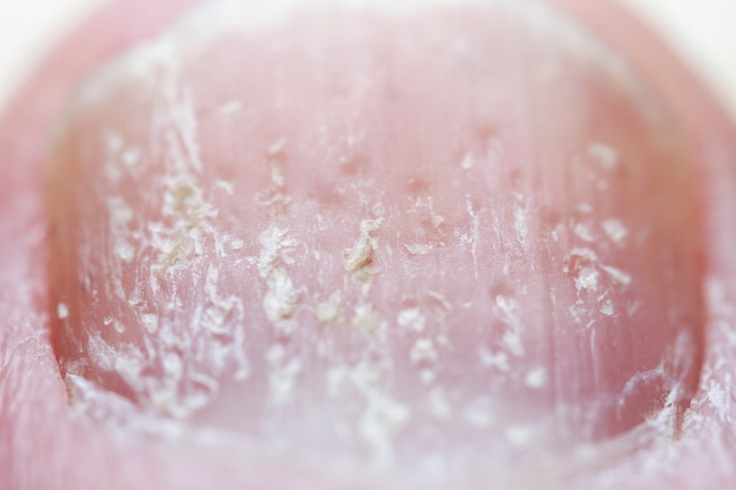 Łuszczyca paznokci nierzadko mylona jest z grzybicą paznokci. By wykluczyć lub potwierdzić grzybicę, wykonuje się badanie mikologiczne /123RF/PICSEL