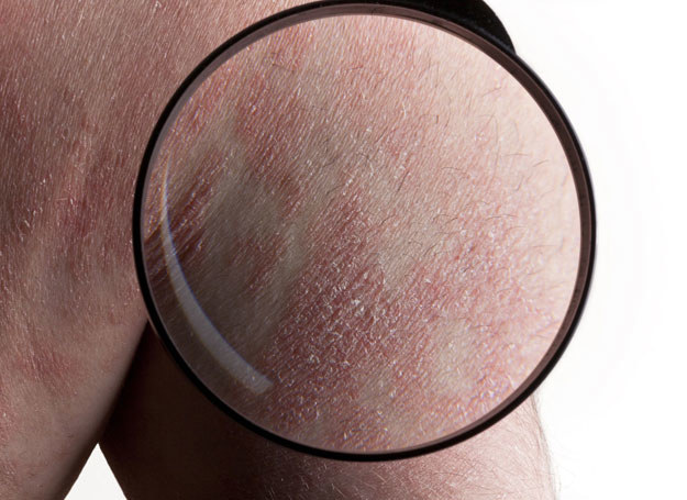 Łuszczyca to choroba zapalna skóry, przewlekła i jak dotąd - nieuleczalna /123RF/PICSEL