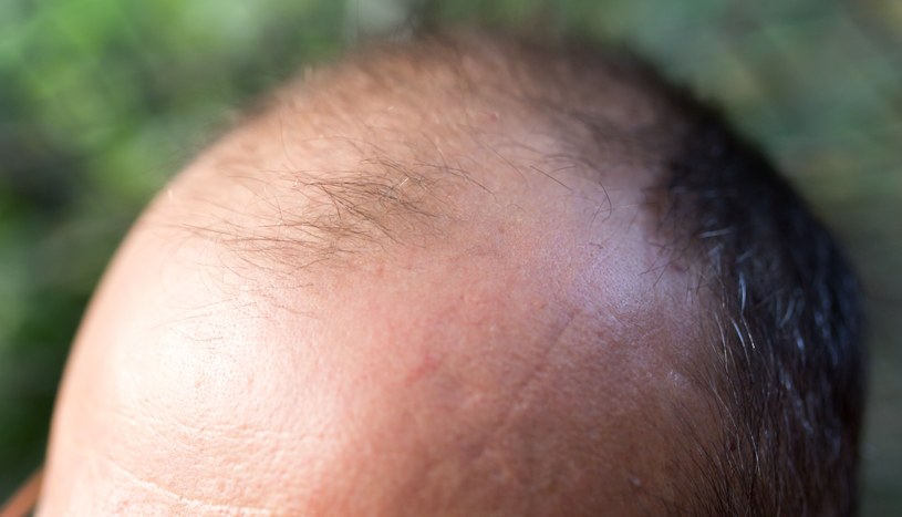Łysienie na czubku głowy oraz tworzenie się tzw. zakol, są efektem zmian hormonalnych w mężczyzn w okresie przekwitania /123RF/PICSEL