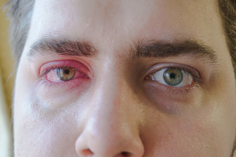 Łzawienie oczu to jeden z objawów alergii /123RF/PICSEL