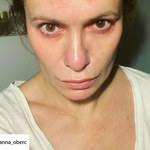 "M jak miłość": Anna Oberc ma problemy skórne. Tak wygląda bez makijażu