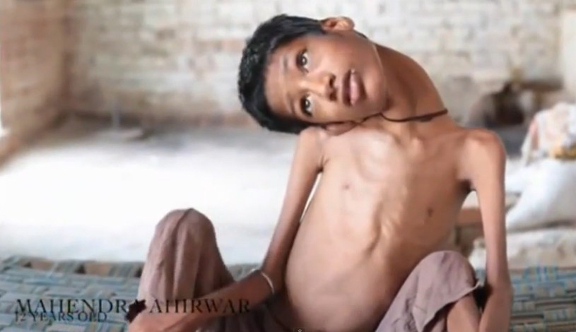 Mahendra Ahirwar ma słabe mięśnie szyi i nie może utrzymać głowy w pionie /YouTube