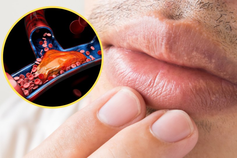 Małe przebarwienia na ustach to tzw.  plamki Fordyce’a - świadczą o problemach z cholesterolem /123RF/PICSEL