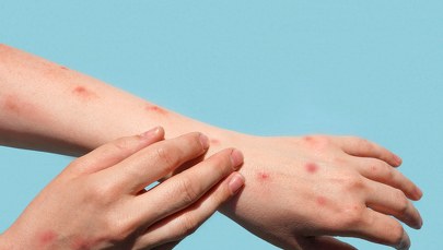 ​Małpia ospa się rozprzestrzenia. Przypadki wykryto już w ponad 80 krajach poza Afryką