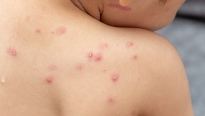 Małpia ospa w UK. Jakie są objawy choroby?