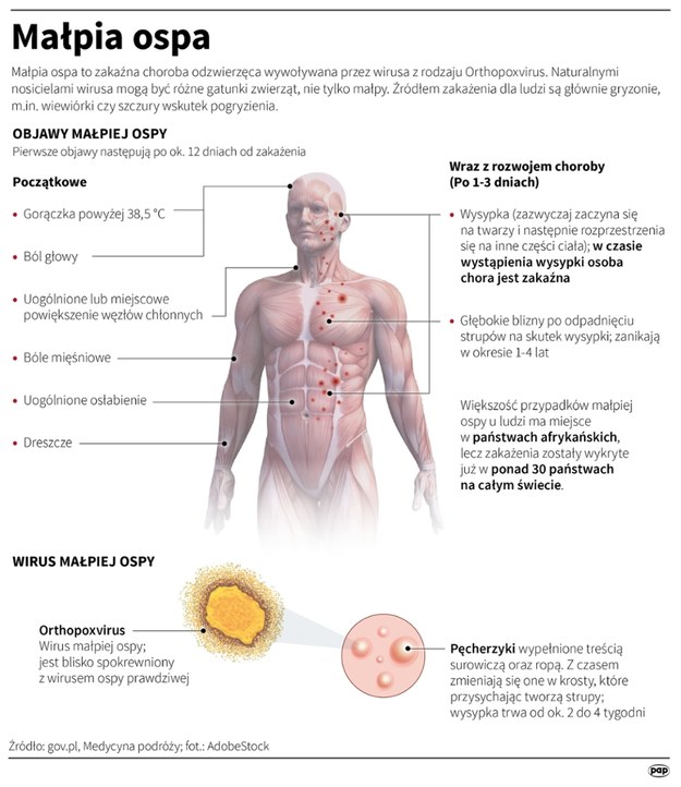 Małpia ospa /Mateusz Krymski /PAP