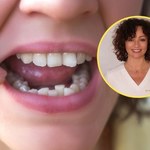 Mama Ortodonta przestrzega przed szybkim prostowaniem zębów. "Ryzykują zdrowie"