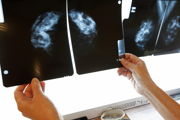 Mammografia nie pomaga w walce z rakiem? /Artur Reszko /PAP
