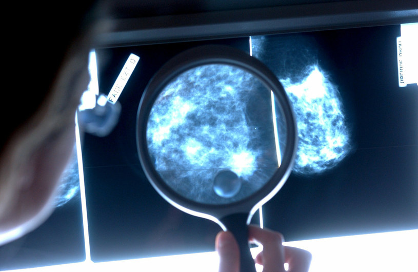 Mammografia to najlepszy sposób, by precyzyjnie rozpoznać nowotwór i skierować pacjentkę na biopsję /East News