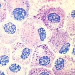 Mastocytoza - trudna do zdiagnozowania choroba nowotworowa