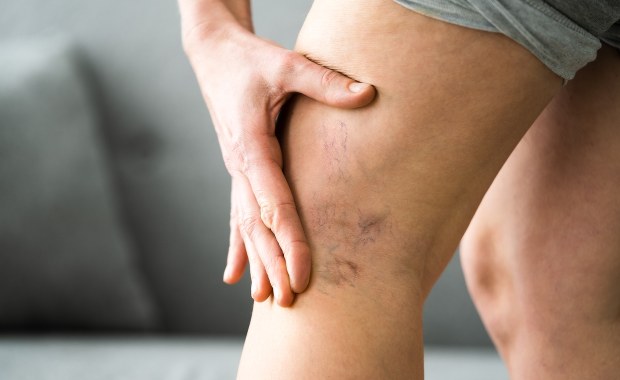 Masz pajączki na nogach? "To może być poważny objaw"