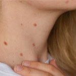 cukrzyca typu 2 Masz takie zmiany na szyi lub pod pachami? Mogą sygnalizować cukrzycę