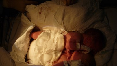 Matka bliźniąt syjamskich: Czuję szczęście, że wszystko się dobrze potoczyło