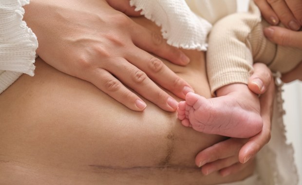 Matki po cesarce cierpią bardziej! Ból i zaburzenia snu realnym zagrożeniem
