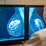 Metody leczenia raka piersi. Nie tylko mastektomia