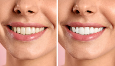 Metody rozjaśniania i wybielania zębów. Która jest dla ciebie?