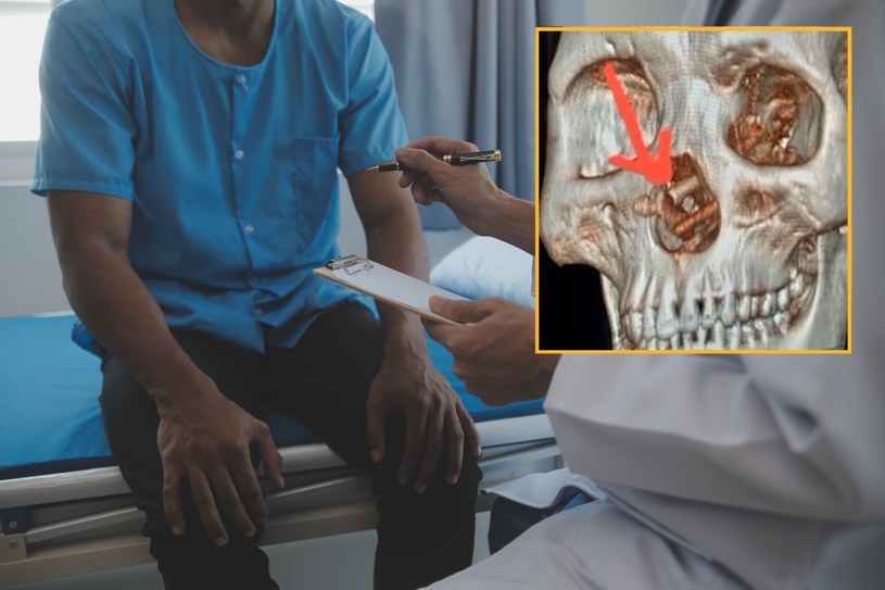 Mężczyzna cierpiał na bóle głowy i utratę wzroku. W jego nosie tkwiły pałeczki