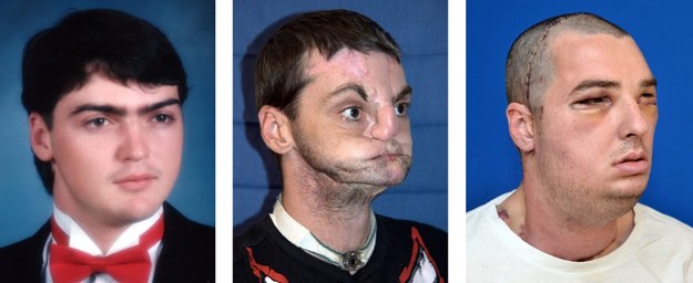 Mężczyzna przed i po operacji /UNIVERSITY OF MARYLAND MEDICAL CENTER /PAP/EPA