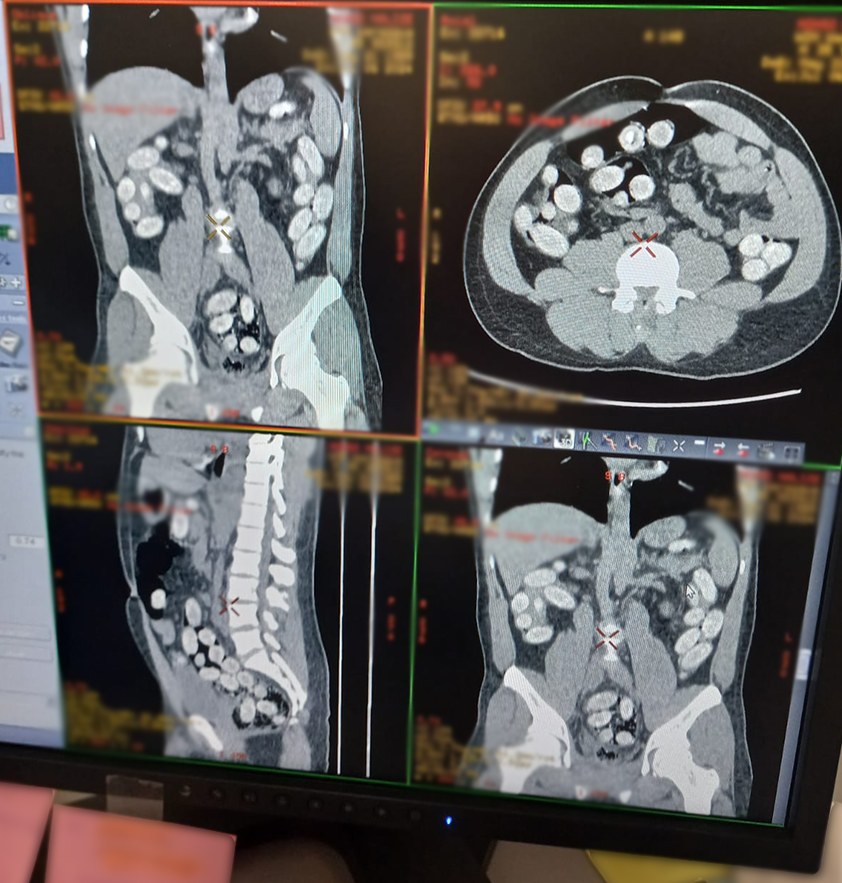 Mężczyzna przemycał ponad 1 kg kokainy w żołądku /KAS /Służba Celna