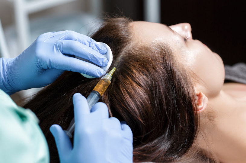 Mezoterapia igłowa może pomóc w przypadku wypadania włosów /123RF/PICSEL