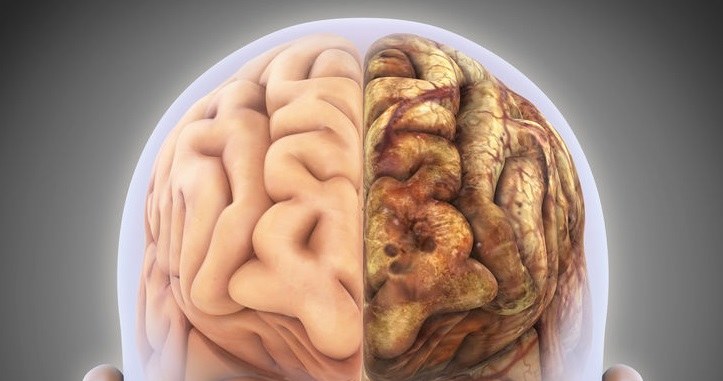 Mgła mózgowa może być objawem poważnych chorób, np. alzheimera /123RF/PICSEL