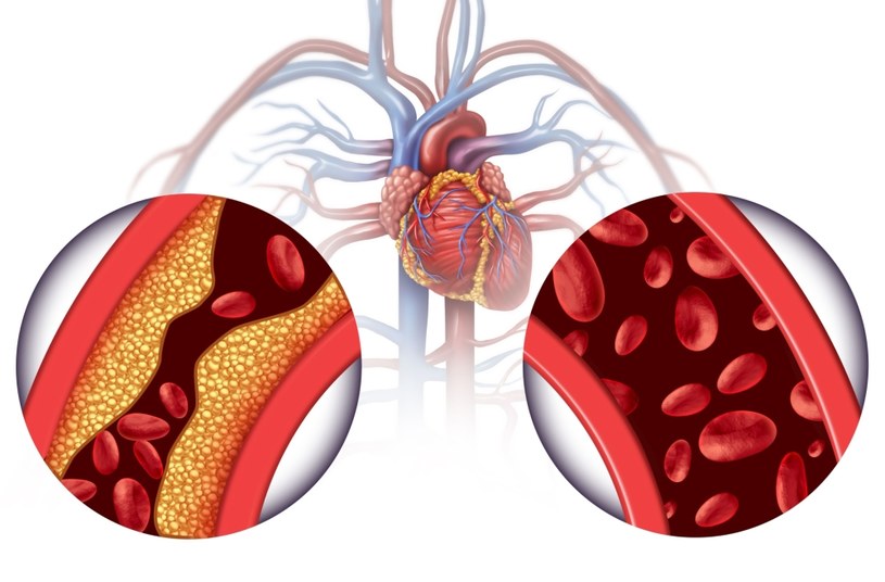 Miażdżyca prowadzi do zawału mięśnia sercowego czy udaru mózgu, które stanowią zagrożenie dla życia pacjenta /123RF/PICSEL