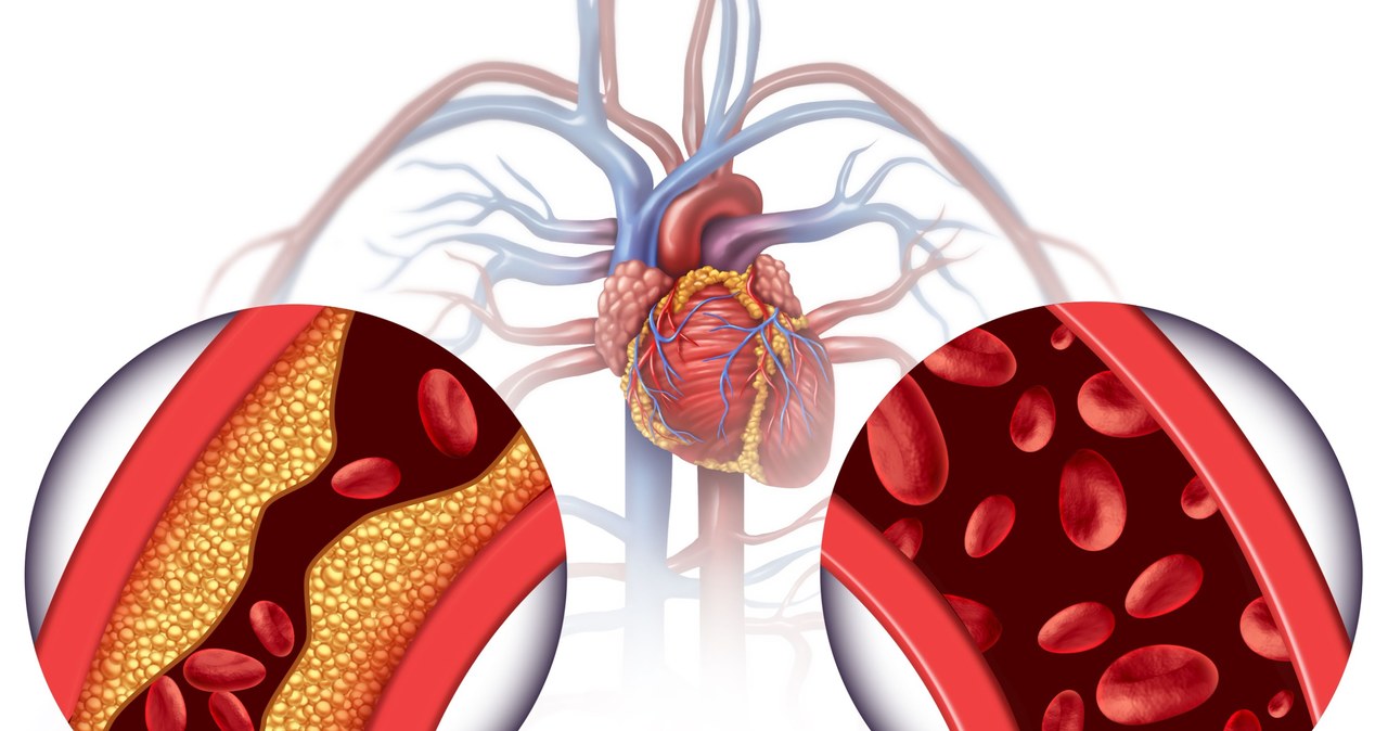 Miażdżyca prowadzi do zawału mięśnia sercowego czy udaru mózgu, które stanowią zagrożenie dla życia pacjenta /123RF/PICSEL