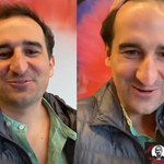Michał Koterski pojechał do Turcji na przeszczep włosów