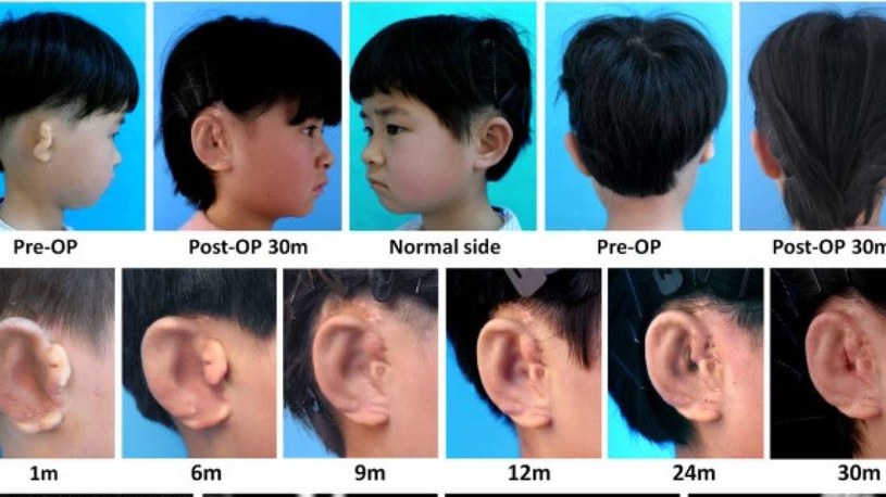 Młoda Chinka jako pierwsza otrzymała ucho zewnętrzne wyhodowane w warunkach laboratoryjnych /fot. EBioMedicine /materiały prasowe