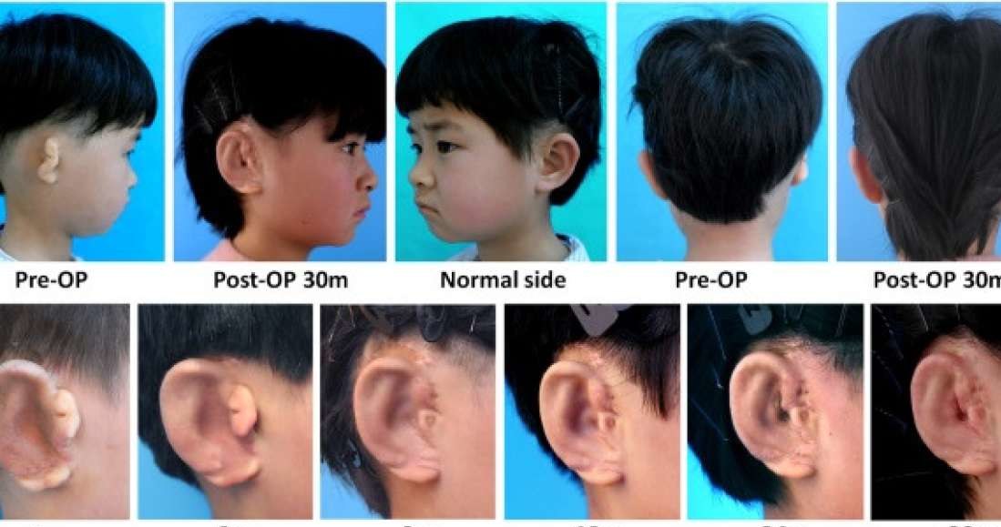 Młoda Chinka jako pierwsza otrzymała ucho zewnętrzne wyhodowane w warunkach laboratoryjnych /fot. EBioMedicine /materiały prasowe