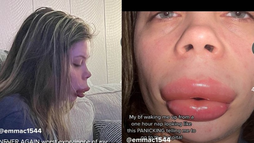 Młoda kobieta powiększyła usta. Doznała poważnej reakcji alergicznej