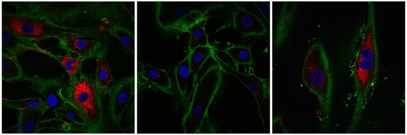 Młode fibroblasty na pierwszym zdjęciu (po lewej), po 10 dniach działania czynnikami Yamanaki (środek), po 13 dniach działania czynnikami Yamanaki (prawa). Kolor czerwony wskazuje na przywróconą produkcję kolagenu /materiały prasowe