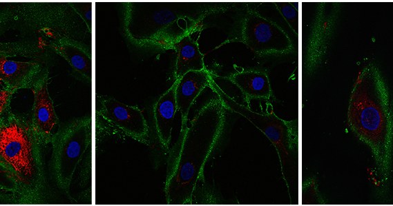 Młode fibroblasty na pierwszym zdjęciu (po lewej), po 10 dniach działania czynnikami Yamanaki (środek), po 13 dniach działania czynnikami Yamanaki (prawa). Kolor czerwony wskazuje na przywróconą produkcję kolagenu /materiały prasowe